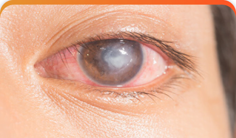 Corneal Infections