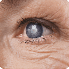 Cataracts General eye Clinic