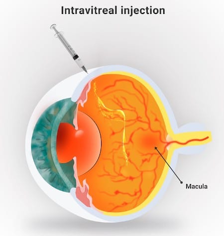 Intravitreal Injections