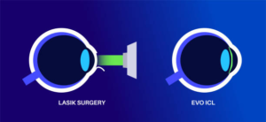 LASIK vs ICL