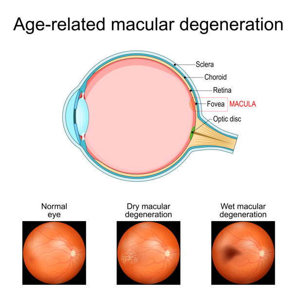 Age-Related Macular Degeneration