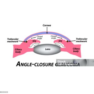 Angle Closure Glaucoma