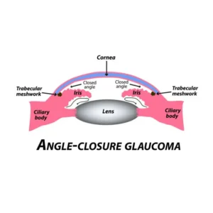 Angle-Closure Glaucoma