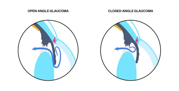 Difference Between Open-Angle and Closed-Angle Glaucoma