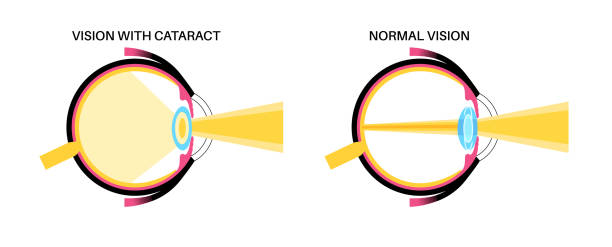 Difference Between Traditional and Laser Cataract Surgery