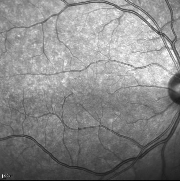 Fluorescein Angiography