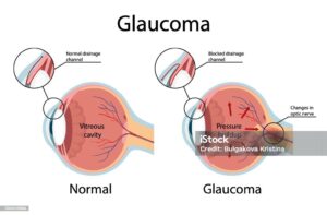 Normal Tension Glaucoma