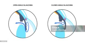 difference between open angle and closed angle glaucoma